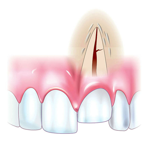 Признаки вколоченного вывиха зуба
